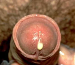 benh-lau-1